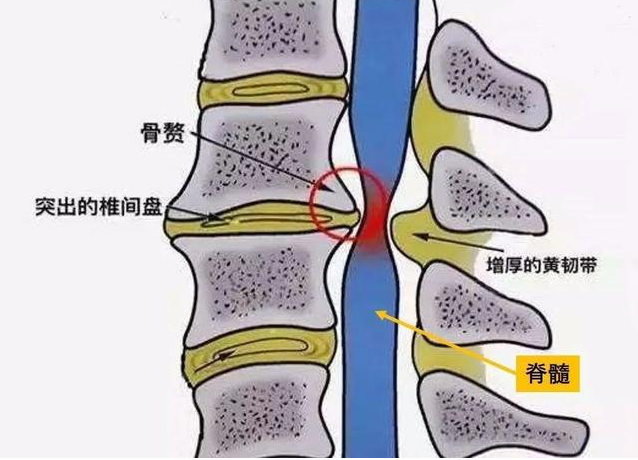椎管狭窄.png